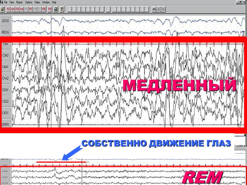 МЕДЛЕННЫЙ REM СОБСТВЕННО ДВИЖЕНИЕ ГЛАЗ